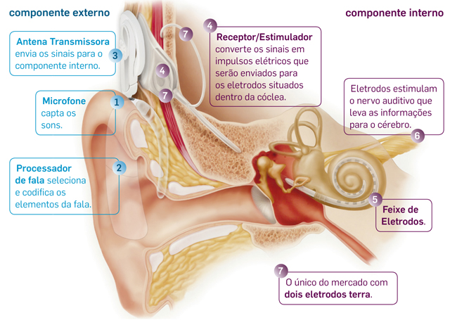 Qual a diferença entre o Implante Coclear e os aparelhos auditivos  convencionais?